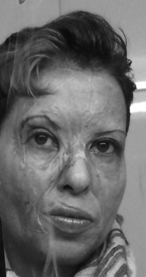 Συγκλονίζει η θωρακοχειρούργος Καλλιόπη Αθανασιάδη 52 χρόνια μετά το φρικτό ατύχημα με τη φωτιά